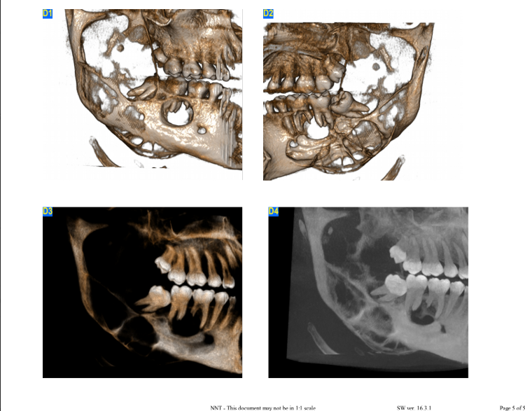Ameloblastoma 3D CBCT