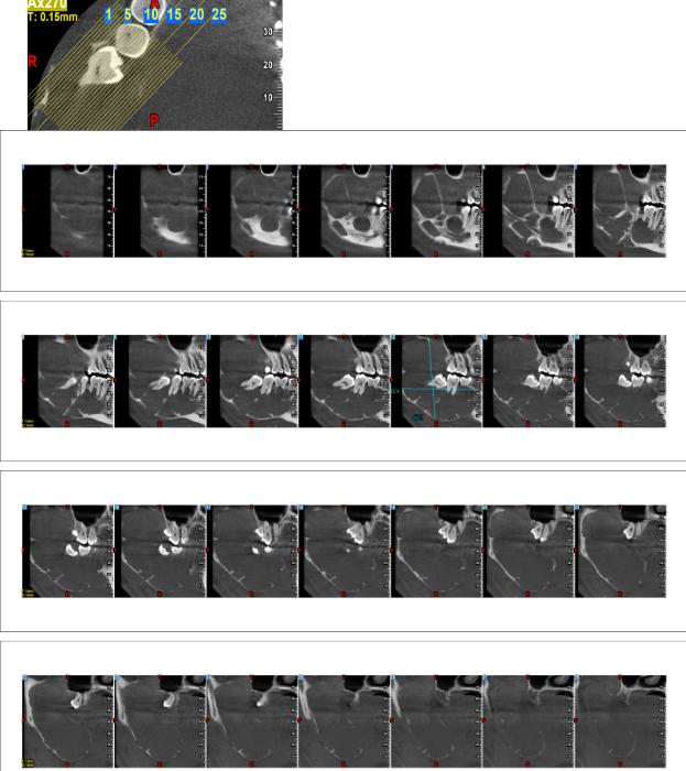 Ameloblastoma sagittal CBCT