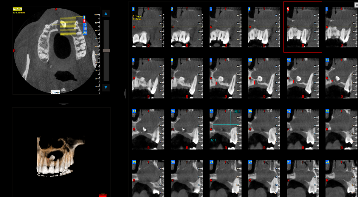 Dentigerous cyst CBCT