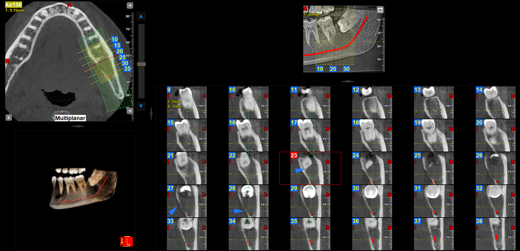 Dentigerous cyst multiplanar CBCT