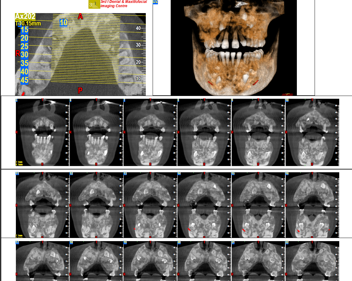 Fibro-osseous lesion CBCT view 1