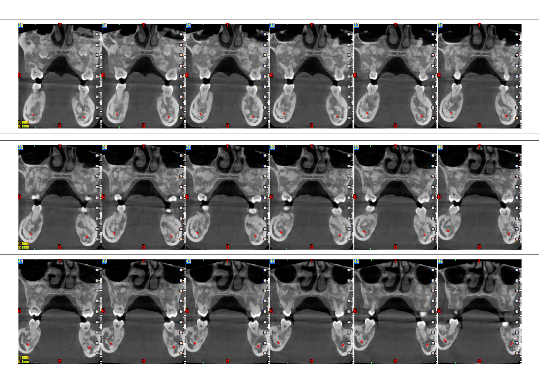 Fibro-osseous lesion CBCT view 2