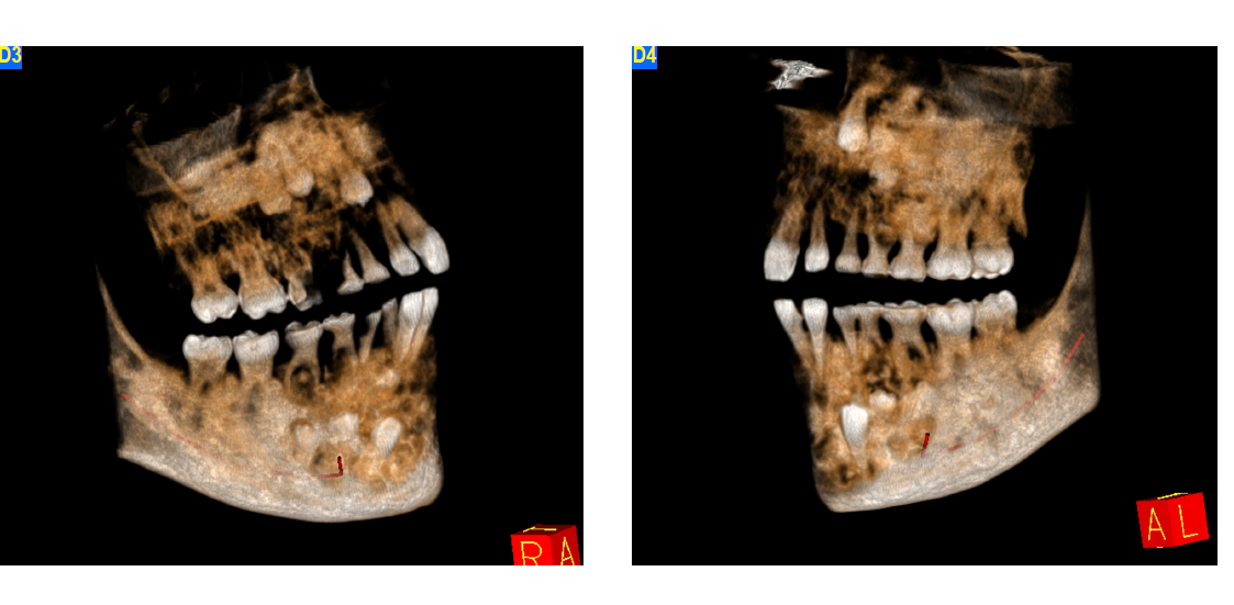 Fibro-osseous lesion CBCT 3D reconstruction