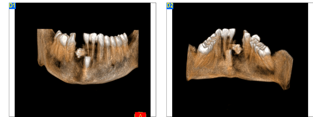 Odontoma 3D CBCT