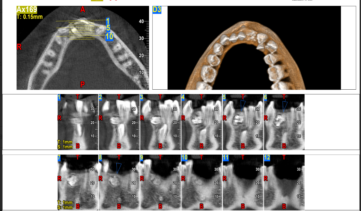 Odontoma coronal CBCT