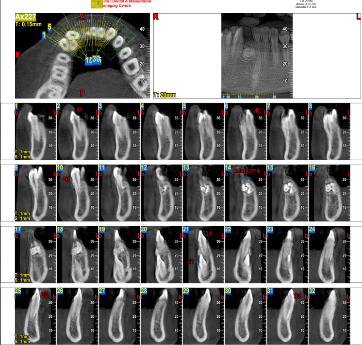 Odontoma cross-sectional CBCT